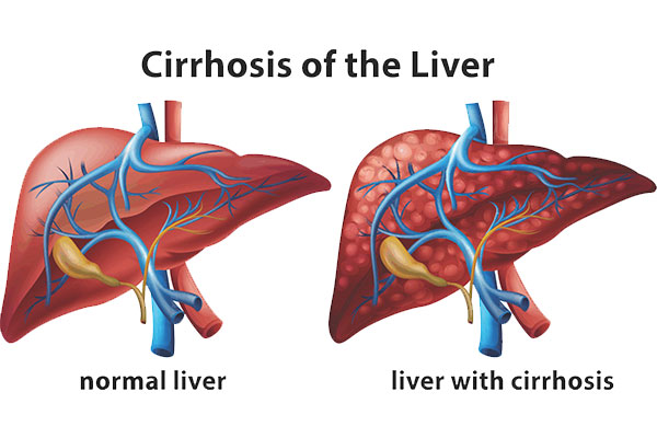 Ayurvedic liver doctor | Ayurvedic liver specialist